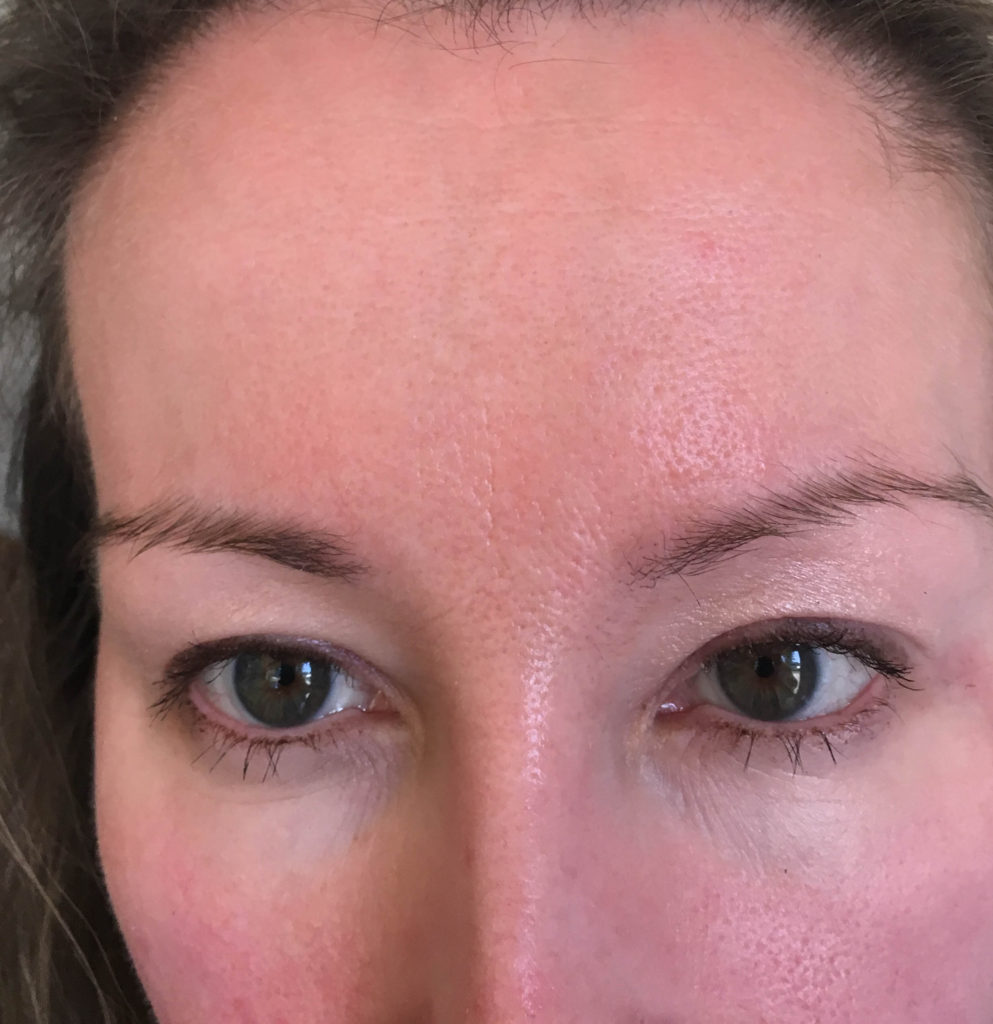 woman's before and after Botox photo 