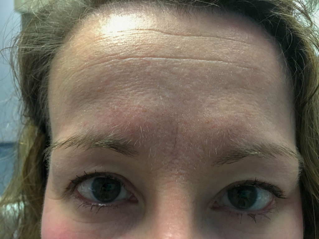 woman's forehead with horizontal forehead lines 