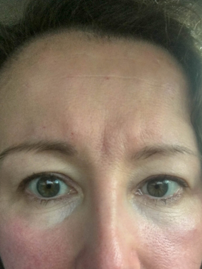 woman's forehead with Botox forehead injection marks 